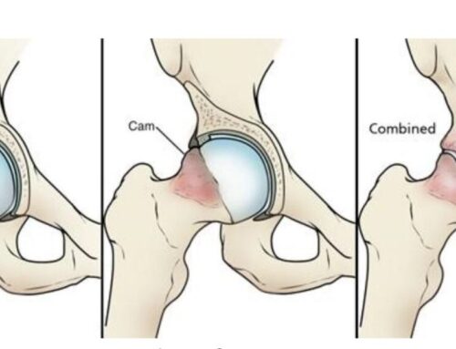 HIP PAIN? UNDERSTANDING FEMORAL-ACETABULAR IMPINGEMENT